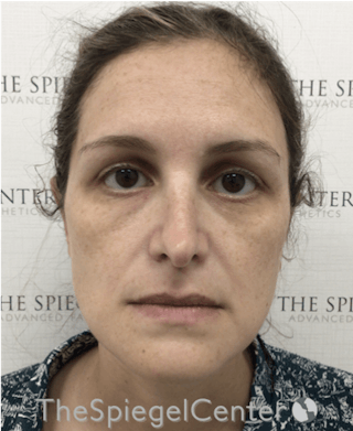 Ear Pinning / Otoplasty Before & After Gallery - Patient 138058 - Image 4