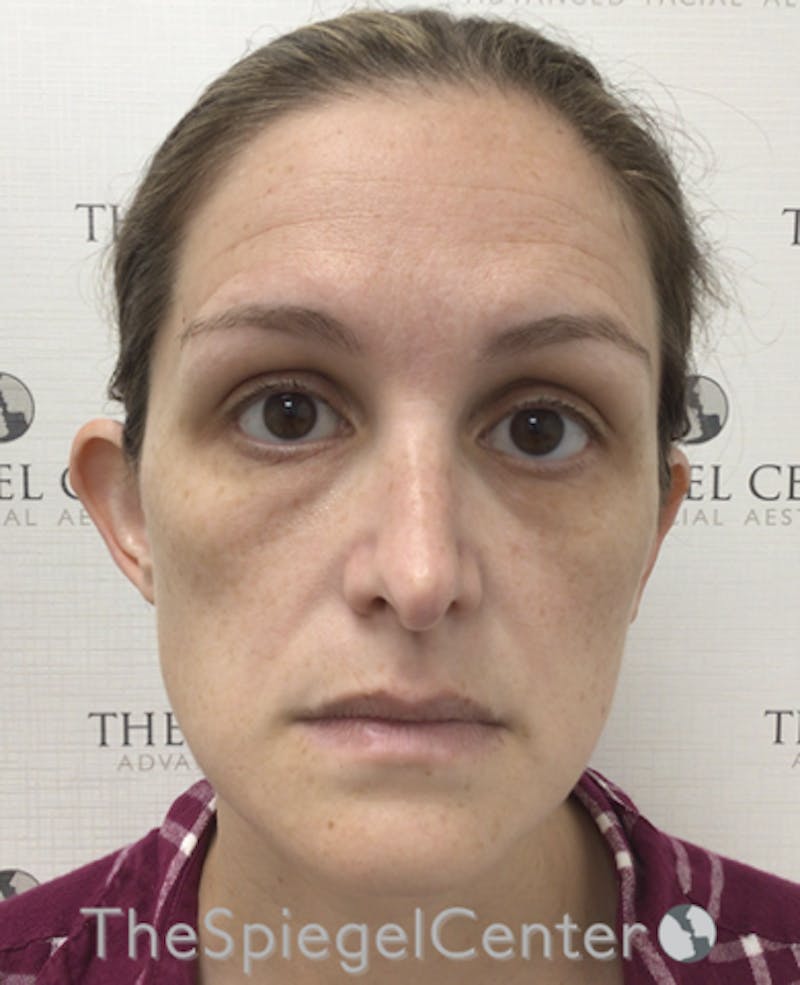 Ear Pinning / Otoplasty Before & After Gallery - Patient 138058 - Image 3