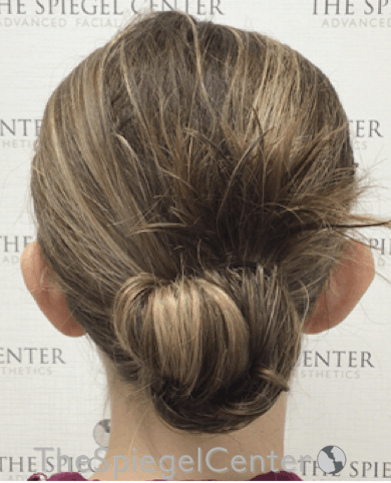 Ear Pinning / Otoplasty Before & After Gallery - Patient 138058 - Image 1