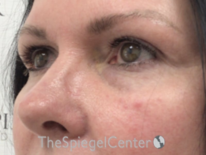 Tear Trough / Under Eye Fillers Before & After Gallery - Patient 382066 - Image 3