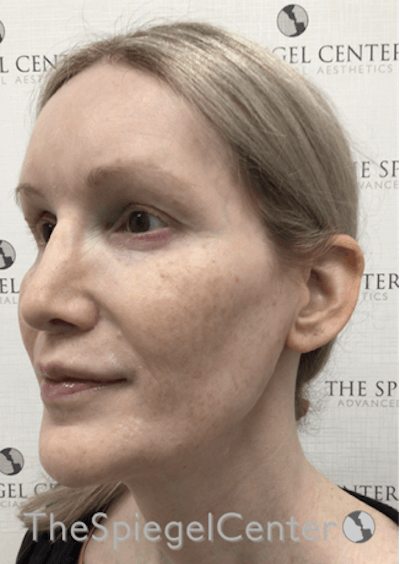 Hair Restoration Before & After Gallery - Patient 215658 - Image 4