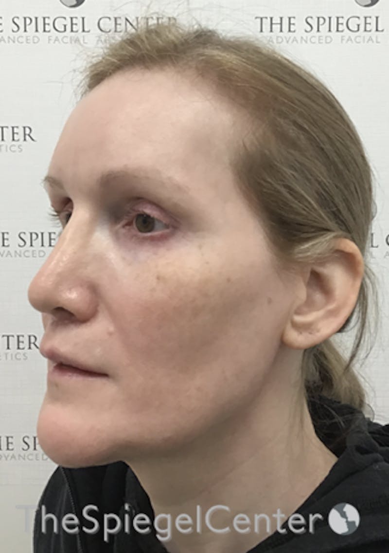 Hair Restoration Before & After Gallery - Patient 215658 - Image 3