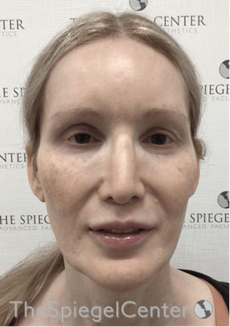 Hair Restoration Before & After Gallery - Patient 215658 - Image 2