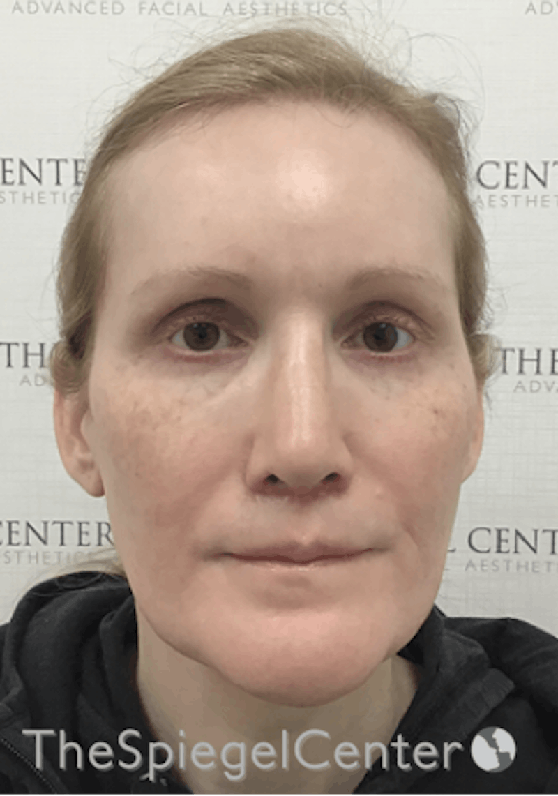 Hair Restoration Before & After Gallery - Patient 215658 - Image 1