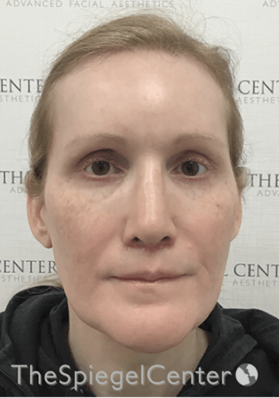 Hair Restoration Before & After Gallery - Patient 215658 - Image 1