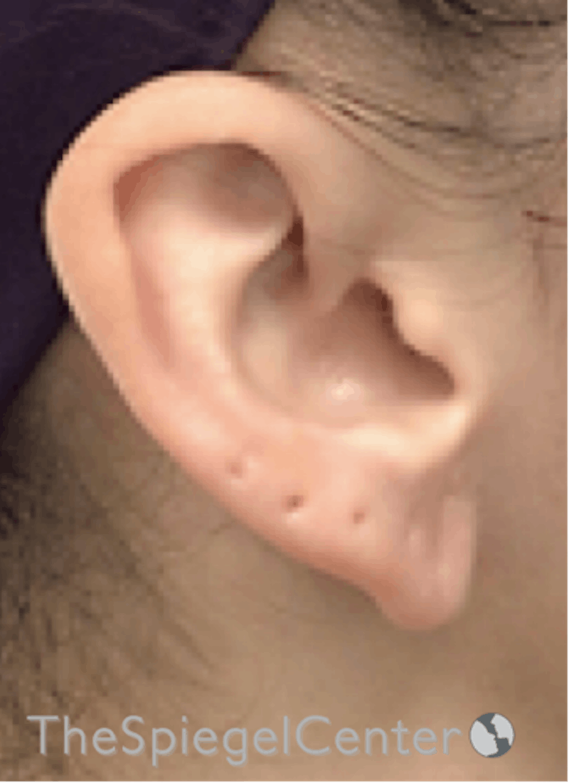 Ear Lobe Repair Before & After Gallery - Patient 170407 - Image 4