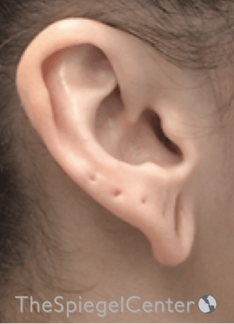 Ear Lobe Repair Before & After Gallery - Patient 170407 - Image 3