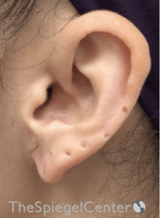 Ear Lobe Repair Before & After Gallery - Patient 170407 - Image 2