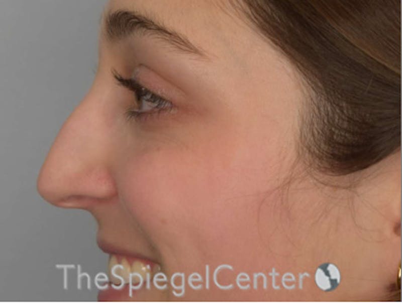 Rhinoplasty Before & After Gallery - Patient 602581 - Image 1