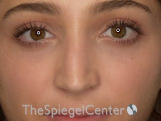 Rhinoplasty Before & After Gallery - Patient 602581 - Image 4