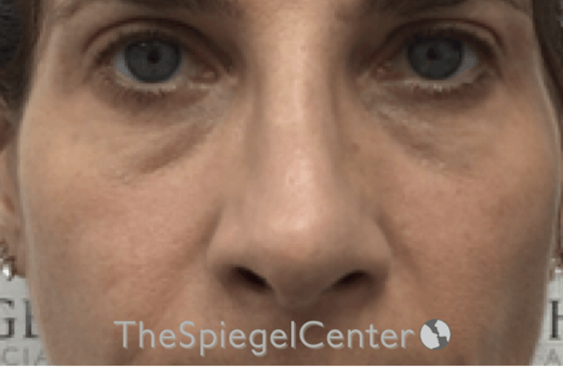 Rhinoplasty Before & After Gallery - Patient 185848772 - Image 4