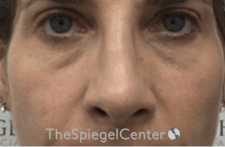 Rhinoplasty Before & After Gallery - Patient 185848772 - Image 4