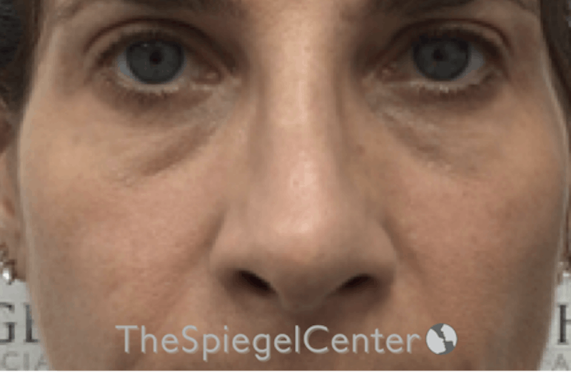 Revision Rhinoplasty Before & After Gallery - Patient 154882 - Image 4