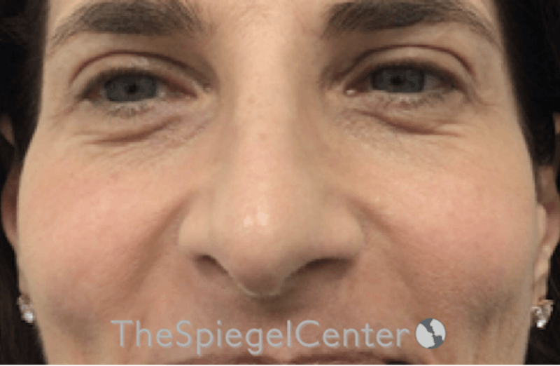 Rhinoplasty Before & After Gallery - Patient 185848772 - Image 3