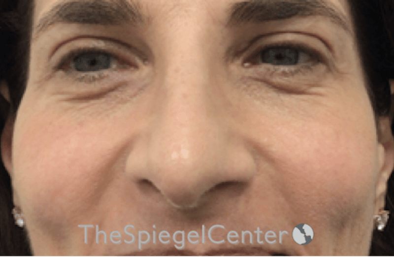 Revision Rhinoplasty Before & After Gallery - Patient 154882 - Image 3
