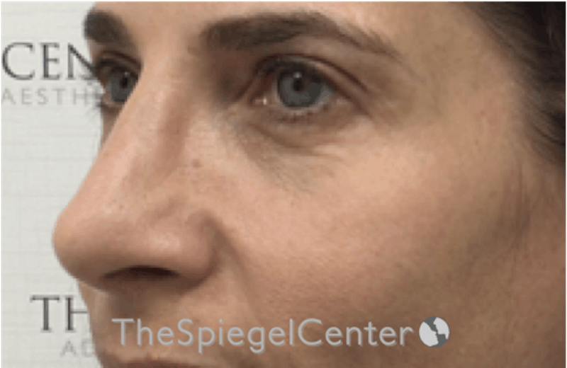 Rhinoplasty Before & After Gallery - Patient 185848772 - Image 2