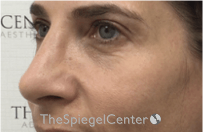 Rhinoplasty Before & After Gallery - Patient 185848772 - Image 2