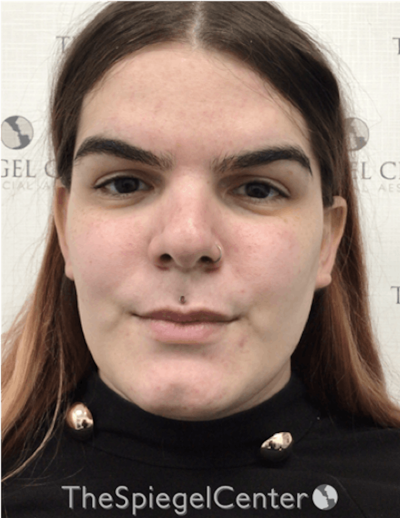 FFS Before & After Gallery - Patient 157140199 - Image 1