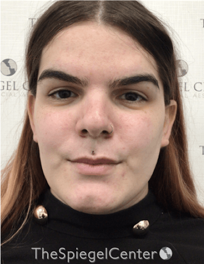 FFS Before & After Gallery - Patient 157140199 - Image 1