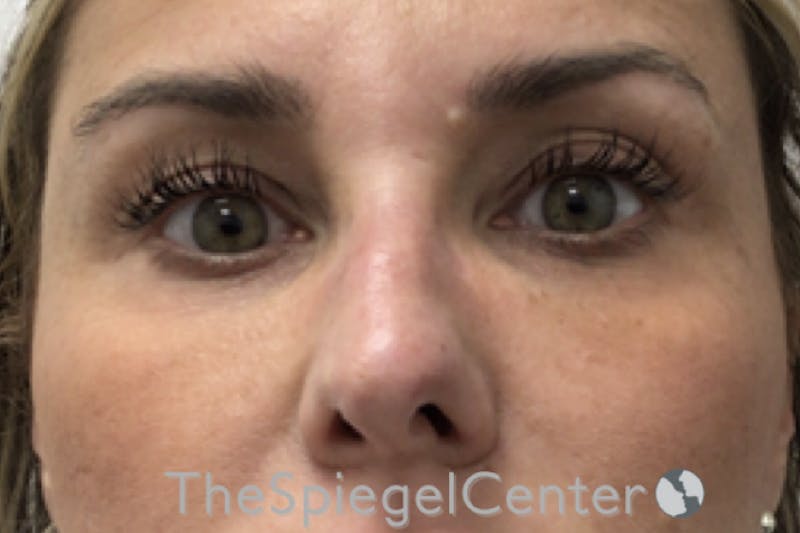 Temple Filler Before & After Gallery - Patient 245633 - Image 2