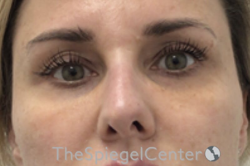Temple Filler Before & After Gallery - Patient 245633 - Image 1