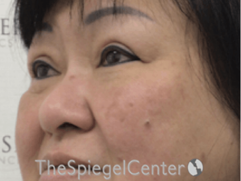 Facetite / Necktite / Embrace / Accutite Before & After Gallery - Patient 256998 - Image 4