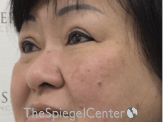Facetite / Necktite / Embrace / Accutite Before & After Gallery - Patient 256998 - Image 4