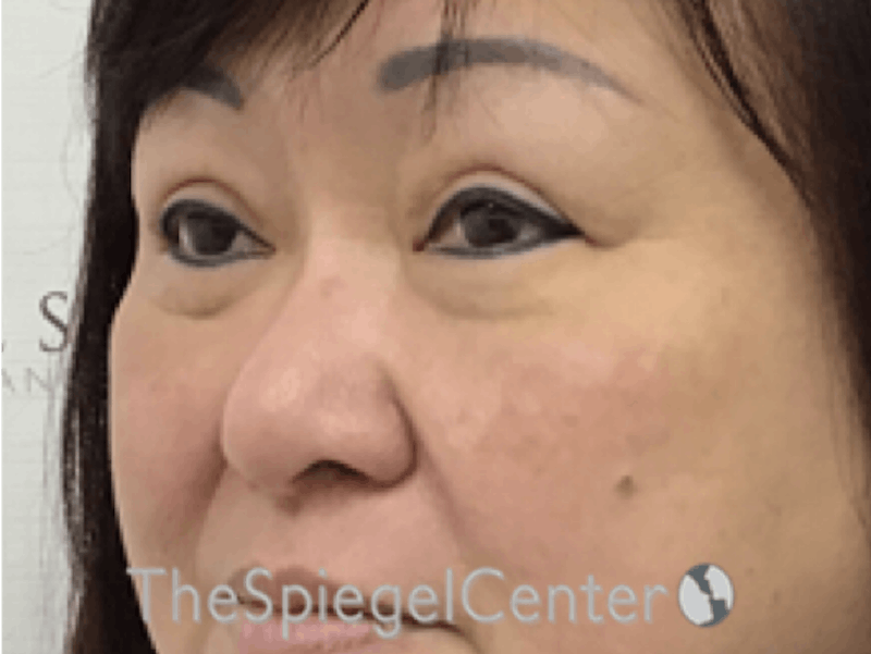 Facetite / Necktite / Embrace / Accutite Before & After Gallery - Patient 256998 - Image 3