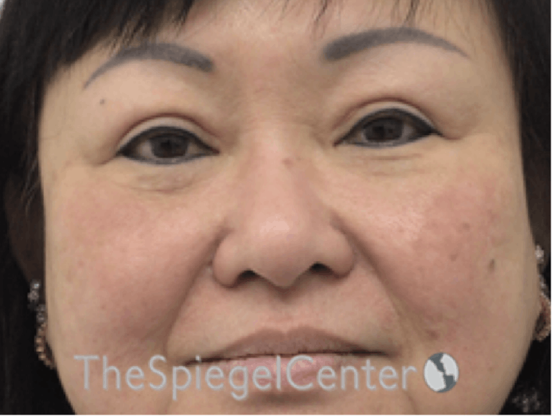 Facetite / Necktite / Embrace / Accutite Before & After Gallery - Patient 256998 - Image 2