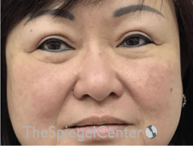 Facetite / Necktite / Embrace / Accutite Before & After Gallery - Patient 256998 - Image 1