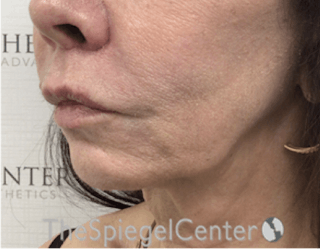 Lip Lift Before & After Gallery - Patient 288495 - Image 4