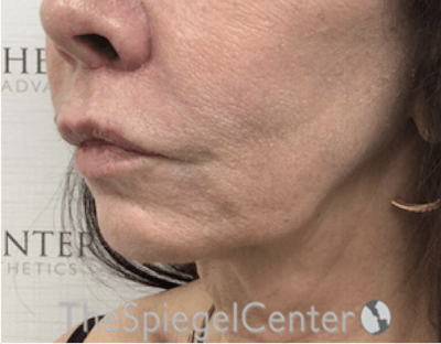 Lip Lift Before & After Gallery - Patient 288495 - Image 4