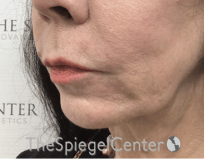 Lip Lift Before & After Gallery - Patient 288495 - Image 3