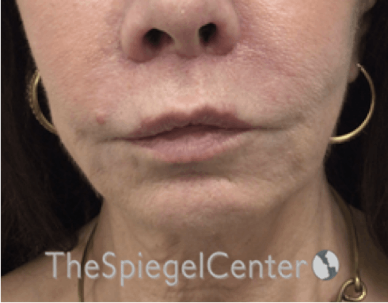 Lip Lift Before & After Gallery - Patient 288495 - Image 2