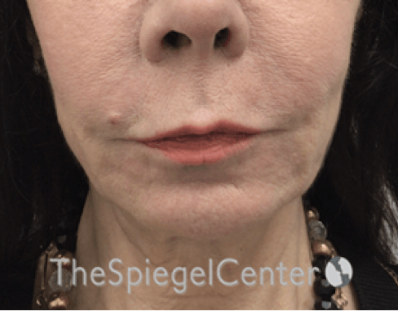 Lip Lift Before & After Gallery - Patient 288495 - Image 1