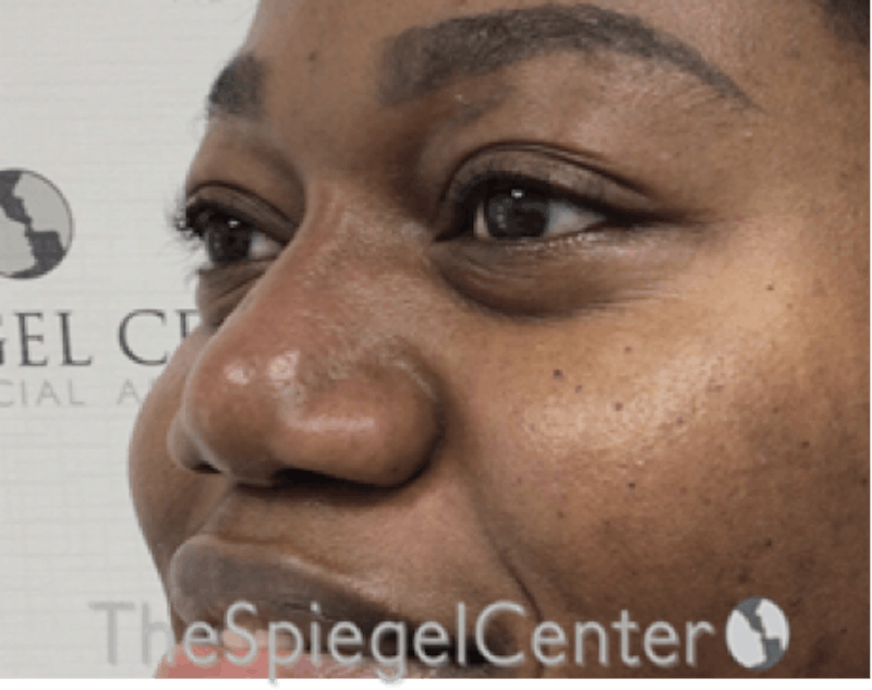 Non-Surgical Rhinoplasty / Nose Filler Before & After Gallery - Patient 190639 - Image 4
