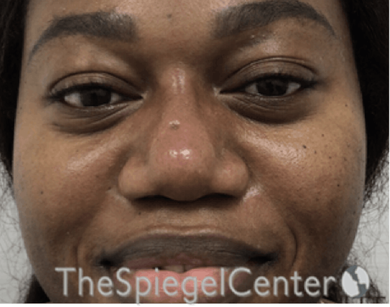 Non-Surgical Rhinoplasty / Nose Filler Before & After Gallery - Patient 190639 - Image 2