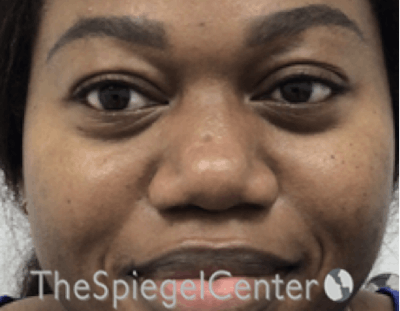 Non-Surgical Rhinoplasty / Nose Filler Before & After Gallery - Patient 190639 - Image 1