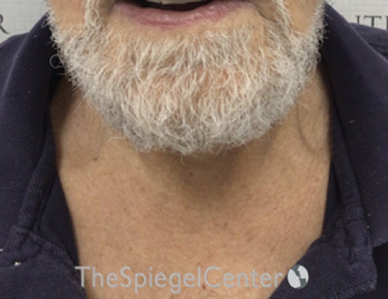 Neck Lift Before & After Gallery - Patient 276217 - Image 4