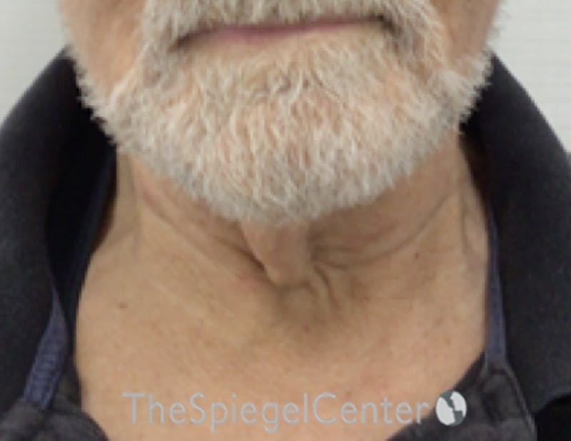 Neck Lift Before & After Gallery - Patient 276217 - Image 3