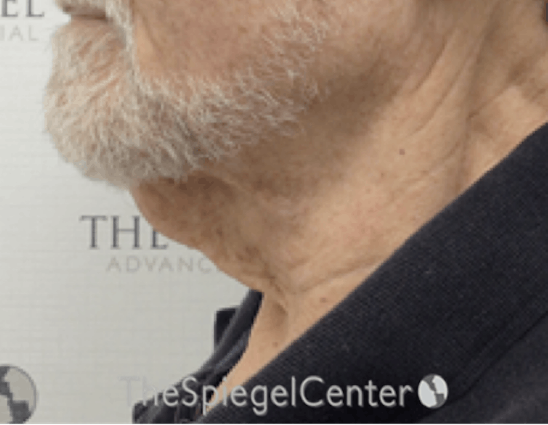 Neck Lift Before & After Gallery - Patient 276217 - Image 1