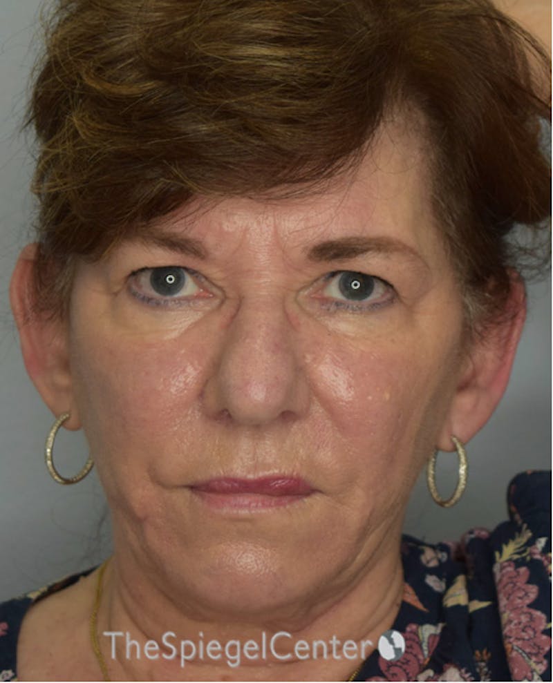 Ear Pinning / Otoplasty Before & After Gallery - Patient 102027 - Image 1