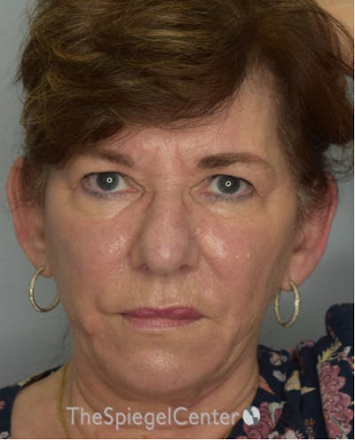 Ear Pinning / Otoplasty Before & After Gallery - Patient 102027 - Image 1