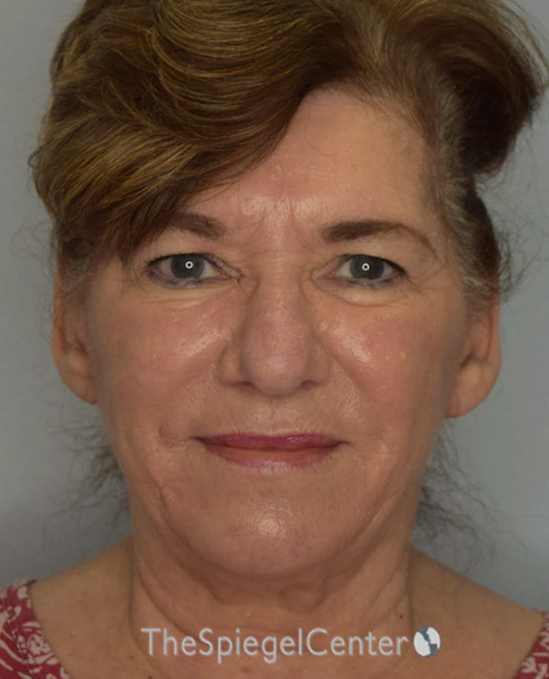 Ear Pinning / Otoplasty Before & After Gallery - Patient 102027 - Image 2