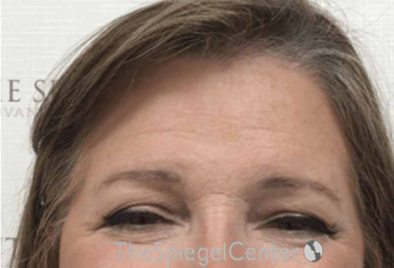 Forehead Contouring Before & After Gallery - Patient 306157 - Image 2