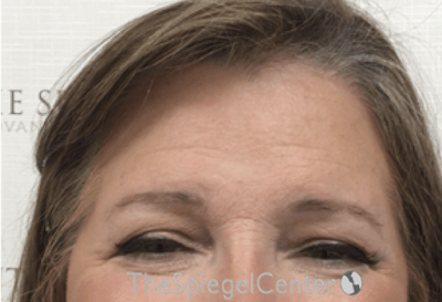 Forehead Contouring Before & After Gallery - Patient 306157 - Image 2