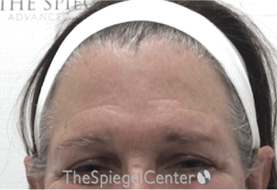Forehead Contouring Before & After Gallery - Patient 306157 - Image 1