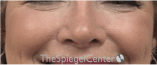 Cheek Implants Before & After Gallery - Patient 237949 - Image 4