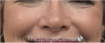 Cheek Implants Before & After Gallery - Patient 237949 - Image 4