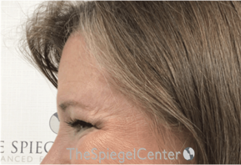Forehead Contouring Before & After Gallery - Patient 306157 - Image 4